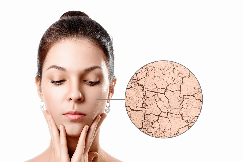 Woman with dry skin and magnified view showing cracked, flaky, dehydrated skin texture