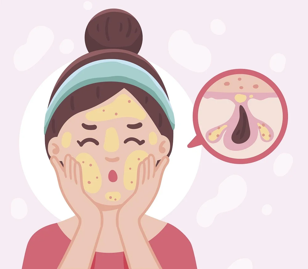 Illustration of woman with oily skin showing shiny T-zone and diagram of clogged pore with excess sebum production