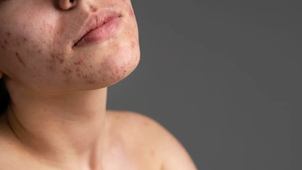 Close-up photograph showing inflammatory acne with active breakouts and post-inflammatory hyperpigmentation on the lower face and jaw area