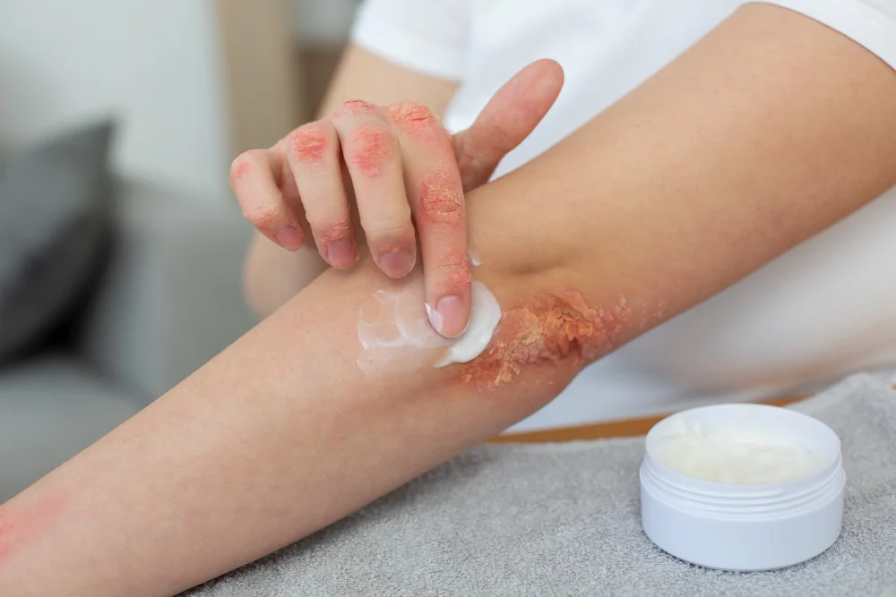 Person applying cream to severe eczema patches showing red, inflamed, and flaky skin on arm and hand