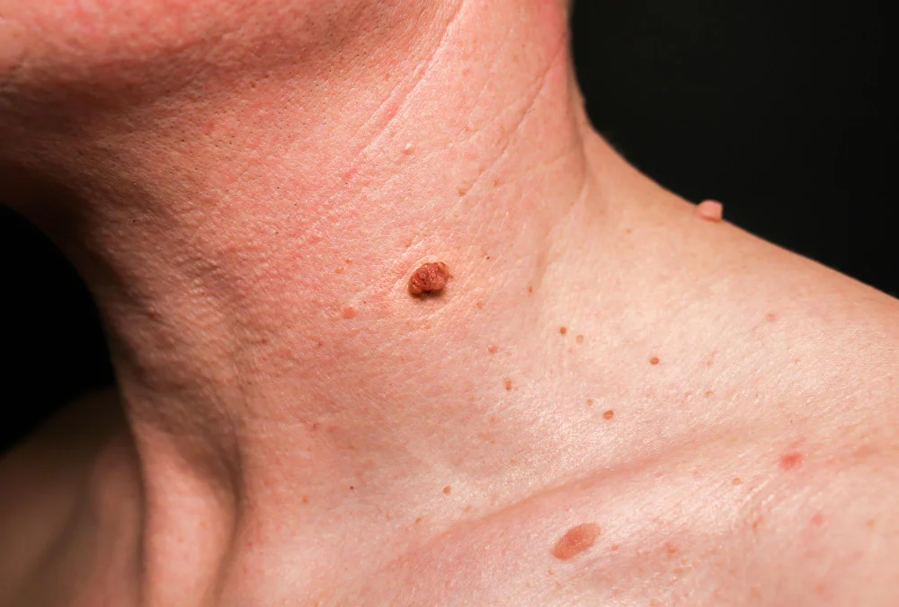Close-up of a raised, irregularly pigmented mole on the neck requiring dermatological examination