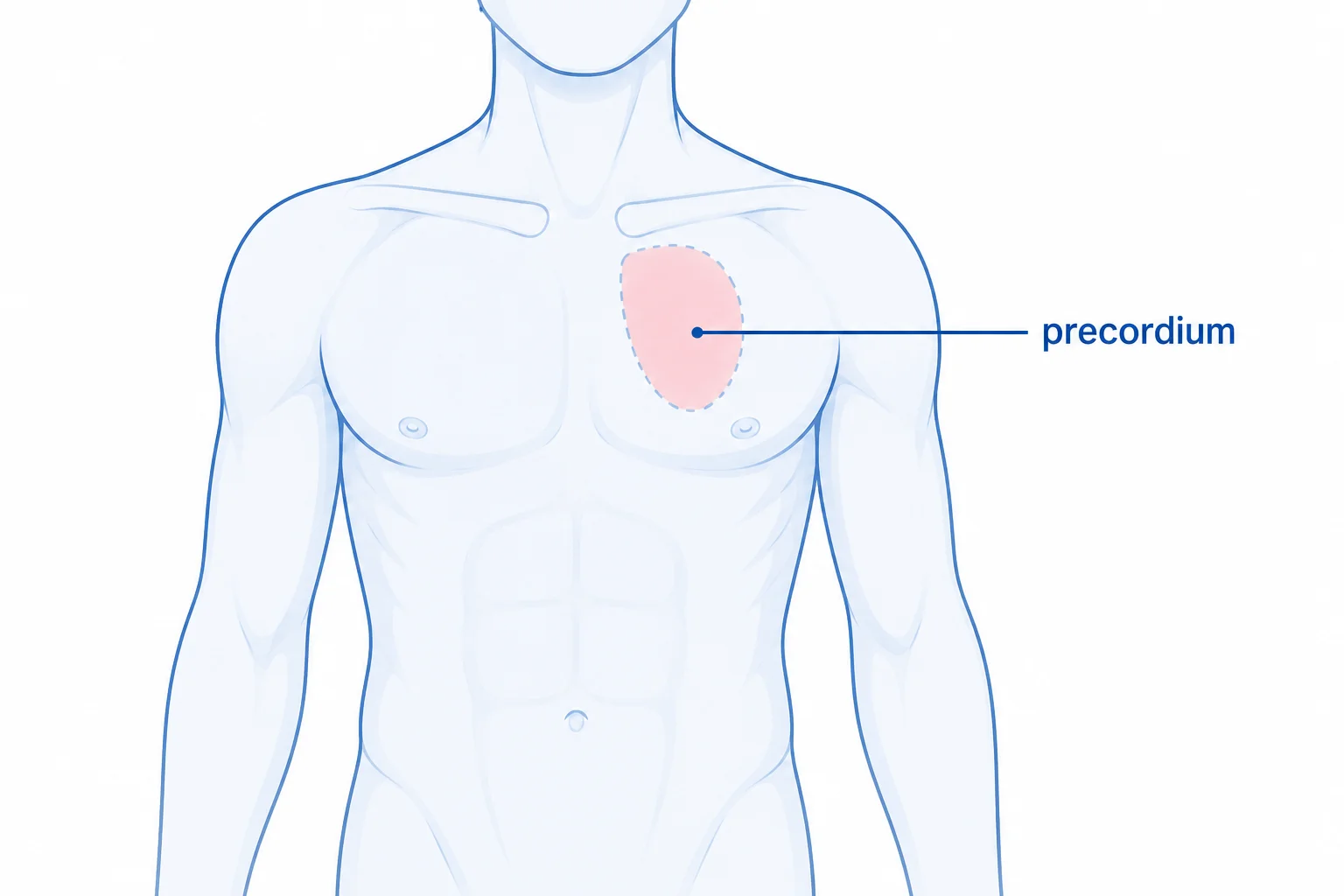 Precordial catch syndrome typically causes sudden, sharp pain in a small area of the left chest near the precordium
