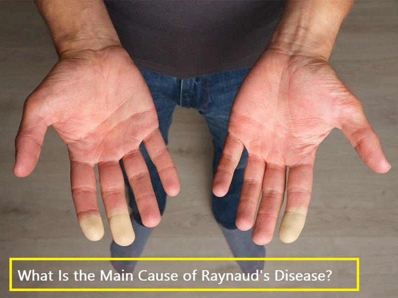 Three stages of a Raynaud's attack shown on a hand: pale white, blue, then red as blood flow returns