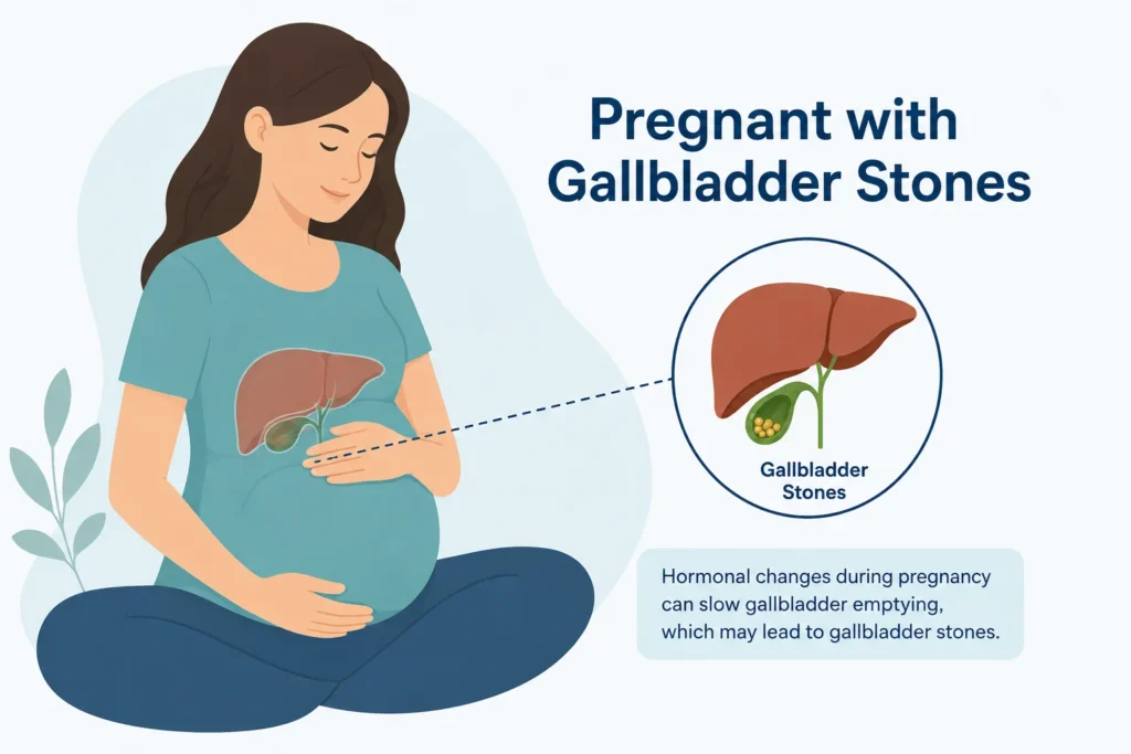 Illustration of a pregnant woman with an anatomical overlay showing the gallbladder location, representing gallbladder stones in pregnancy